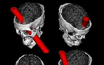 A rendering of the brain injury sustained by the famous patient, Phineas Gage. This case study helped scientists understand the brain systems involved in value-based decision-making. 