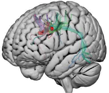 Figure 5. Patients with drug-resistant epilepsy who are candidates for neurosurgical treatments will sometimes have electrodes implanted to help guide neurosurgery plans. Using diffusion weighted imaging (DWI), we can visualize the brain connections that intersect with the contact points of the electrodes. Brain connections in the figure are represented by green and purple colored lines. Electrode contacts are represented in the figure by red spheres). Using electrical stimulation, we seek to understand the